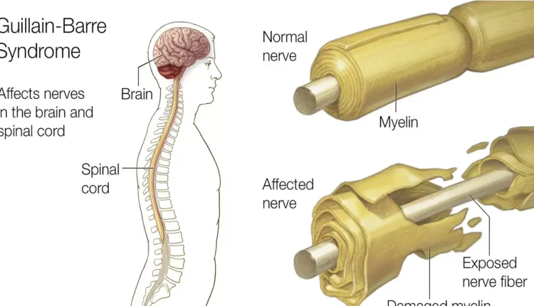 Guillain-Barre Syndrome